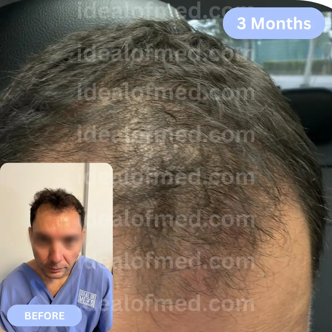 O.C. (38) from Romania hair transplant after 3 months (4150 grafts DHI)