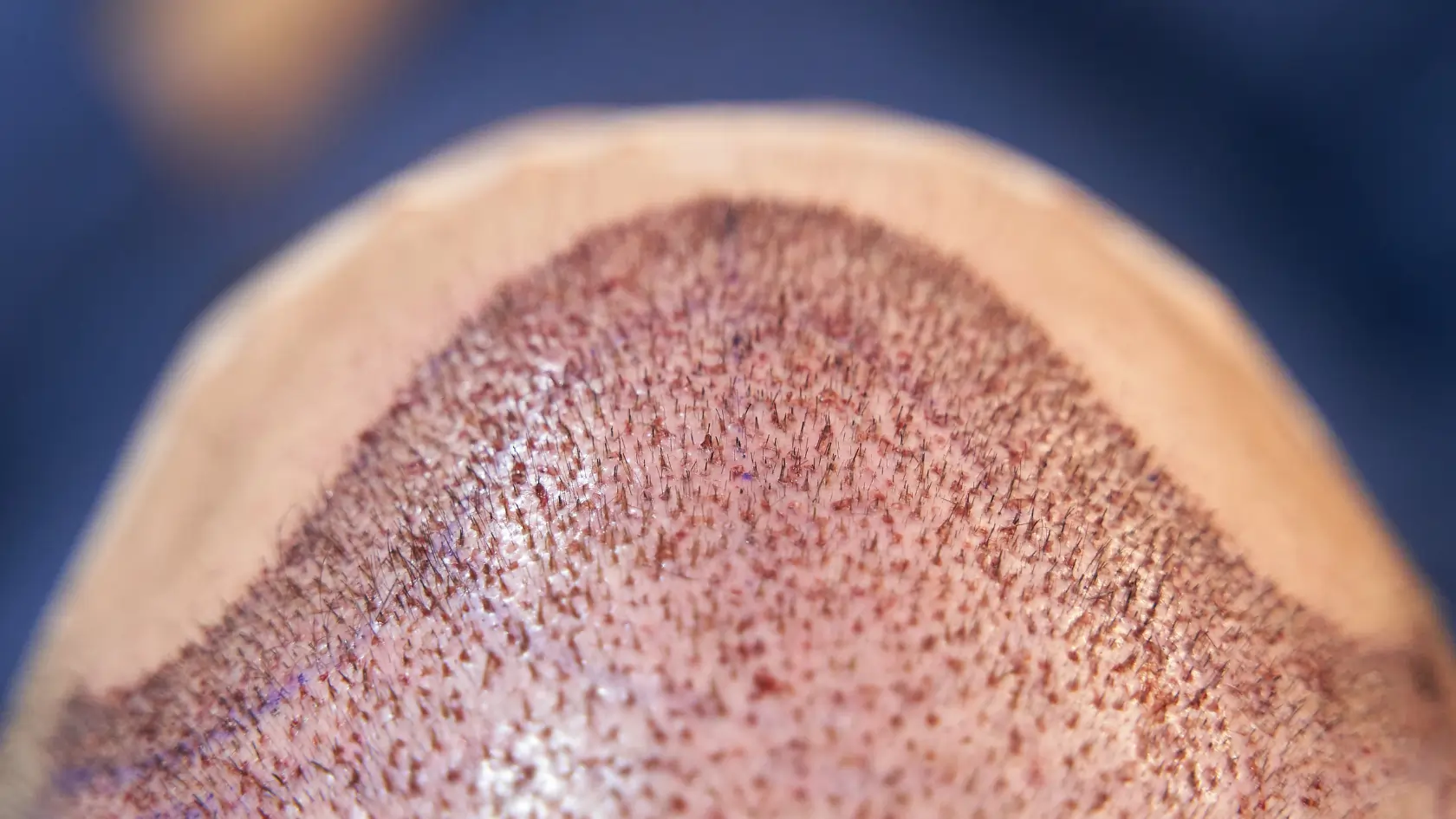 What causes Trypophobia? Overcoming Hair Transplant Trypophobia