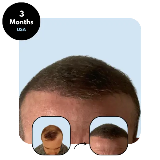 R. J. (39) from USA 3 months after hair transplant