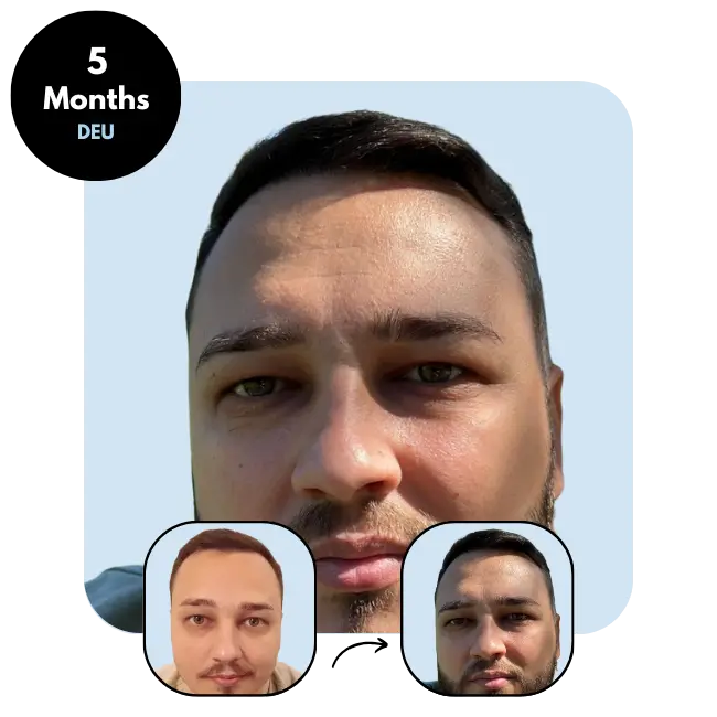 R.J. (32) from DEU (Germany) hair transplant after 5 months (3800 grafts FUE)
