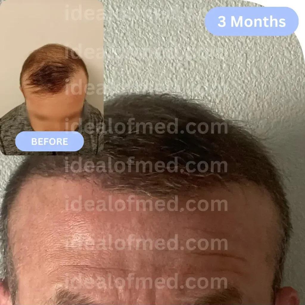R.J. (32) from USA hair transplant after 3 months (3800 grafts FUE)