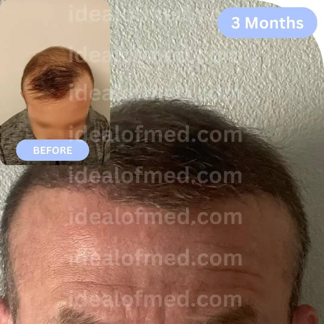 R.J. (32) from USA hair transplant after 3 months (3800 grafts FUE)
