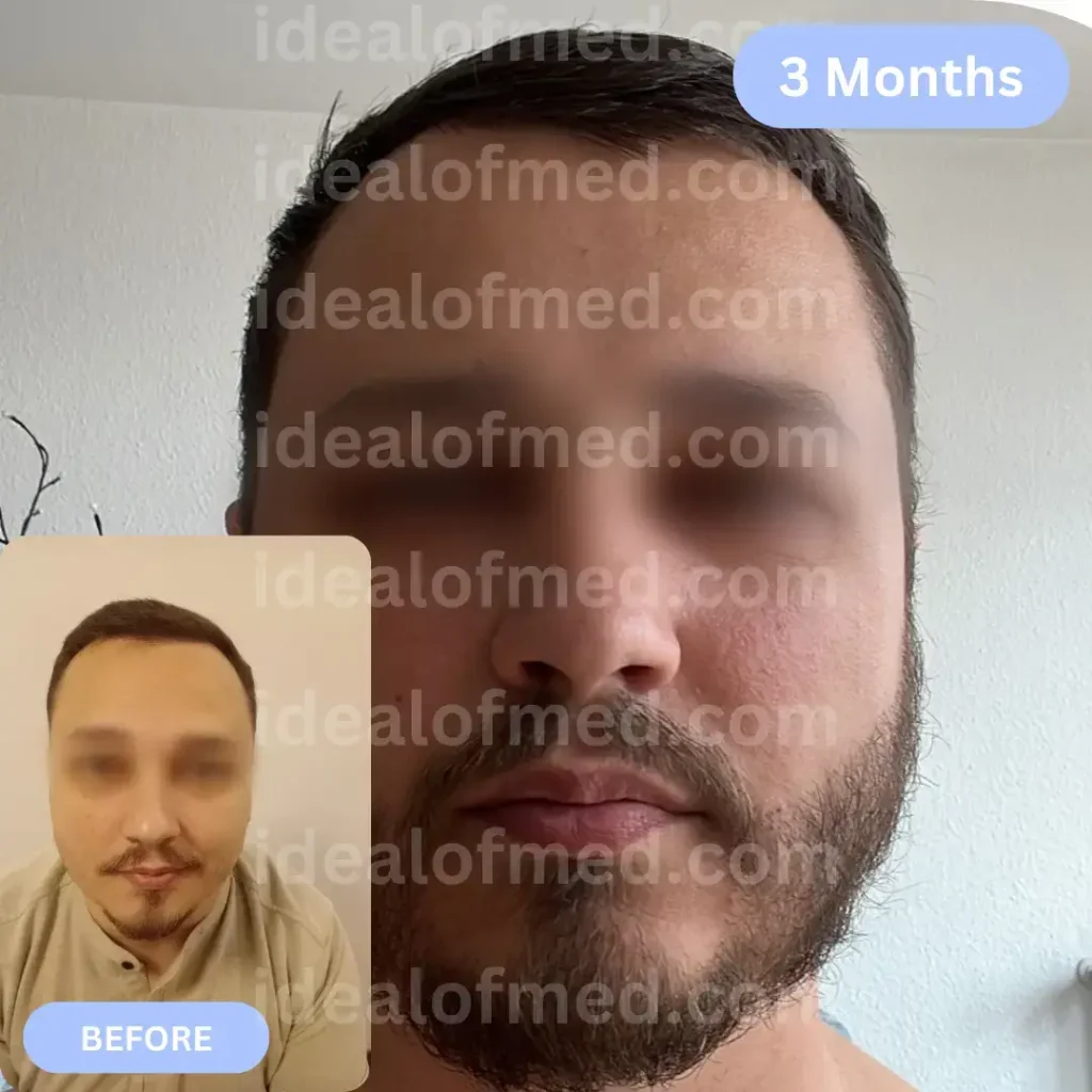 R.U. (32) from Germany hair transplant after 3 months (4150 grafts Mix)