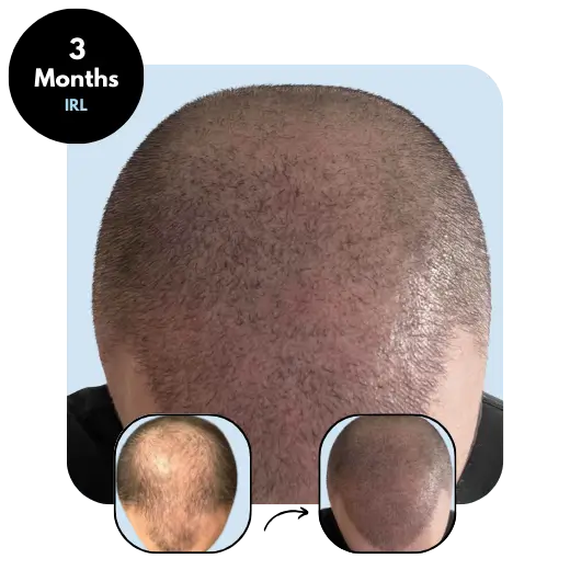 S. M. (24) from IRL 3 months after hair transplant