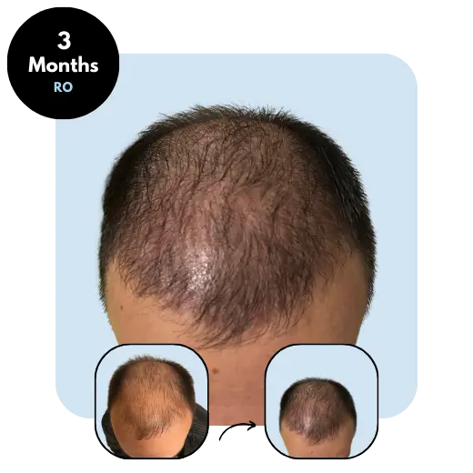 S. P. (32) from RO 3 months after hair transplant