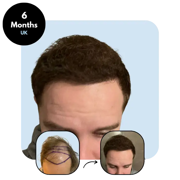 S.B - UK 28yo FUE (5800 grafts) - 6 months after hair transplant