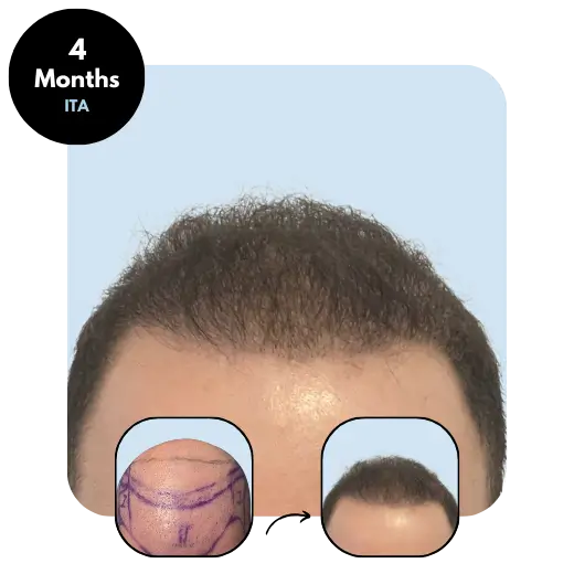 S.J. (36) from Italy hair transplant after 4 months

