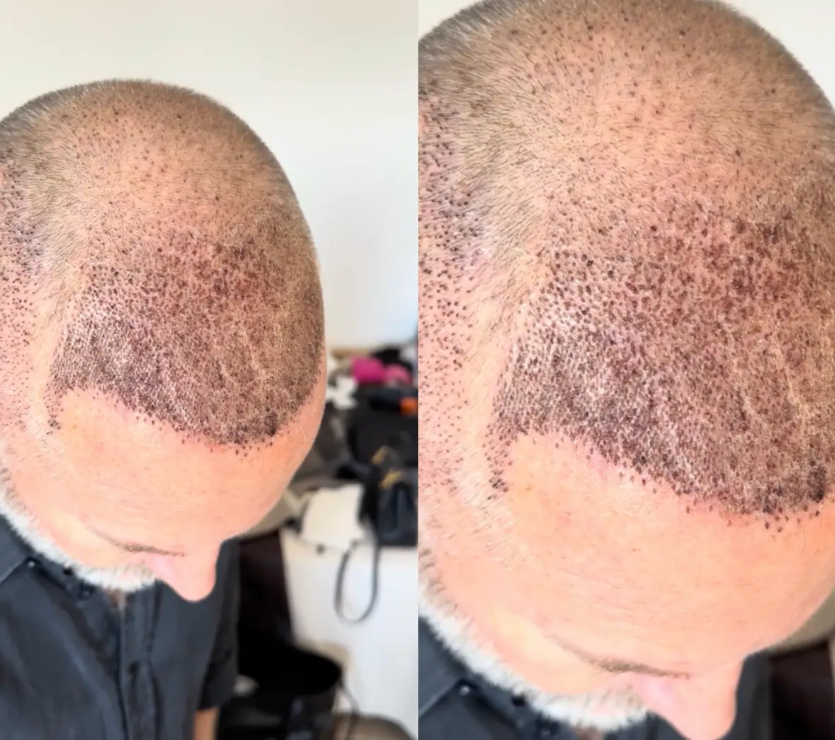 Scabs day 6 itching