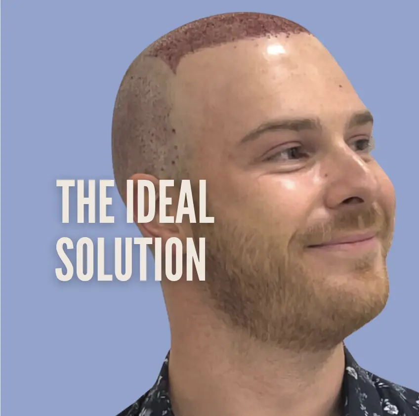 Hair transplant testimonial Nick Wookey