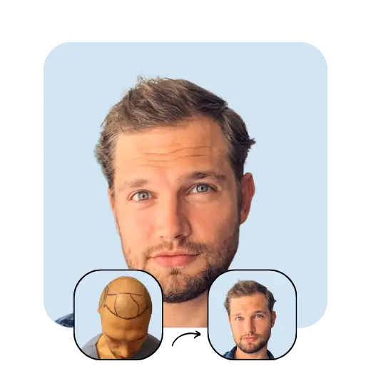 Stefan Pollman Hair transplant before after 2 years Idealofmed