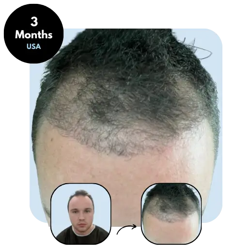 T. D. (19) from USA 3 months after hair transplant