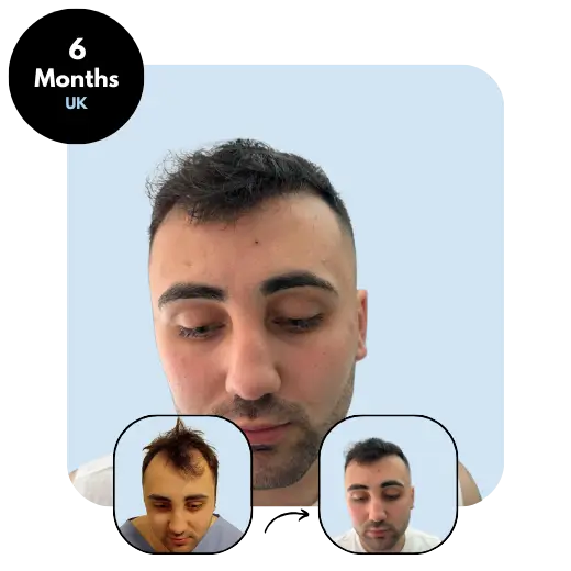 T. Y. - UK 25yo MIX (3000 grafts) - 6 months after hair transplant