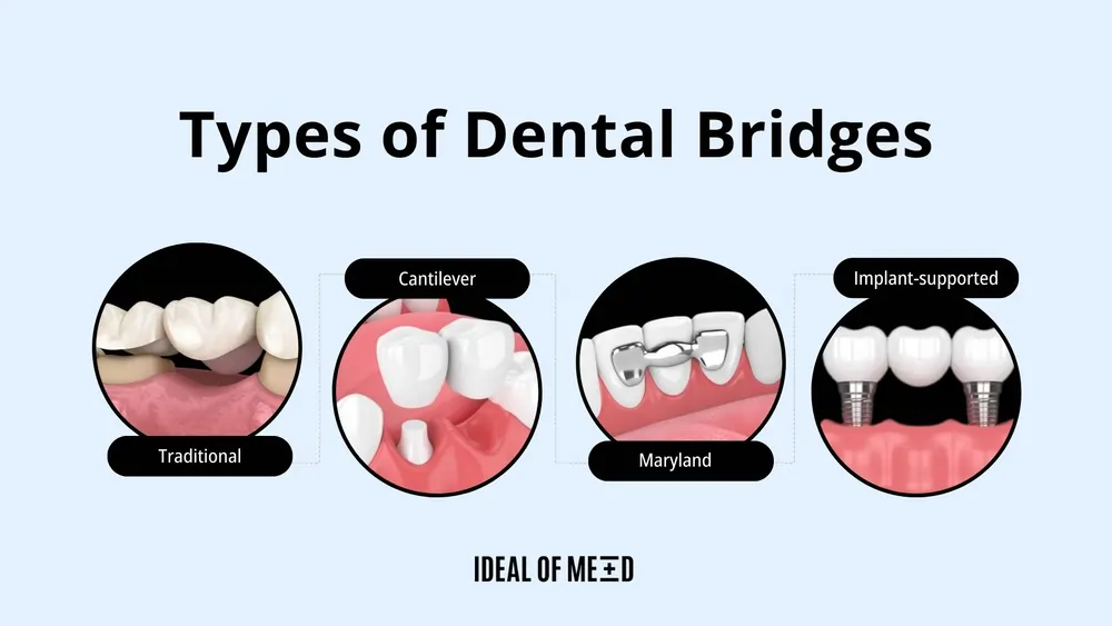 Dental Bridge Benefits Types And Cost 2024