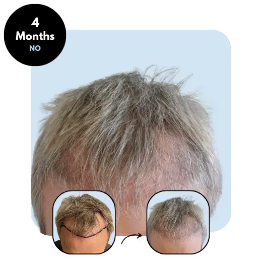 V.A. (43) from Norway after hair transplant month 4
