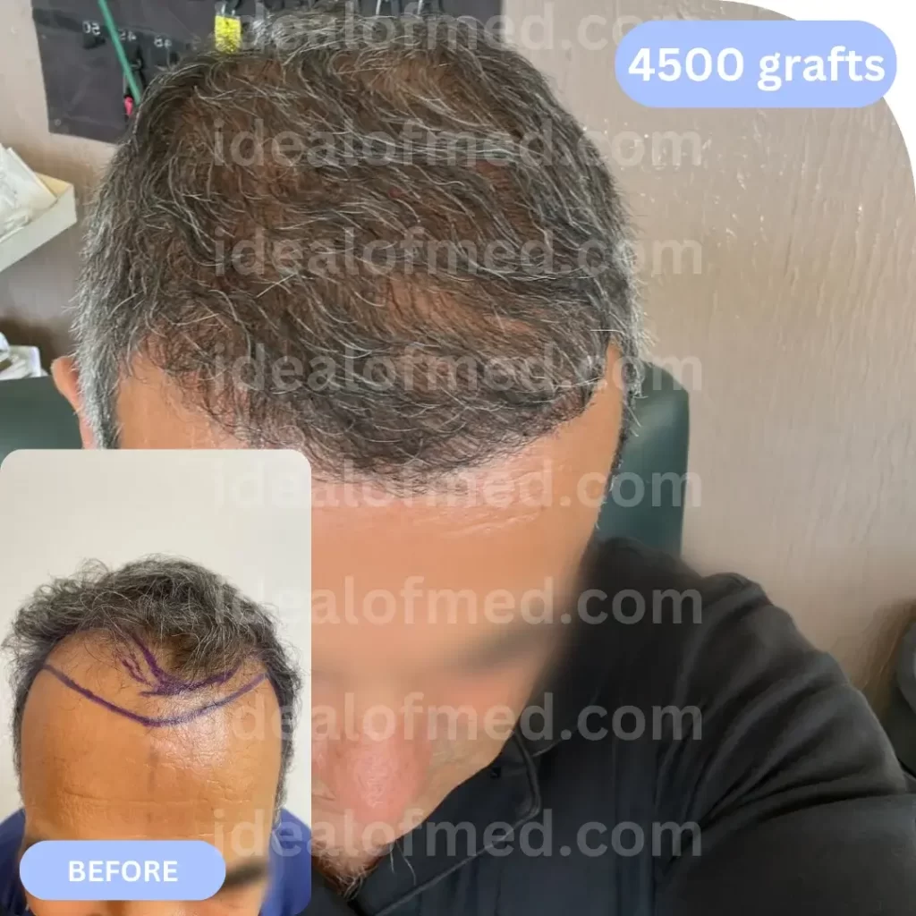 V.S. (55) from USA after hair transplant 12 months (Mix 4500 grafts)