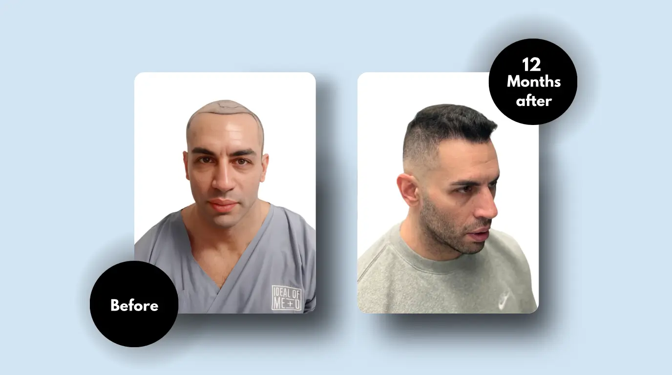 before and after page idealofmed