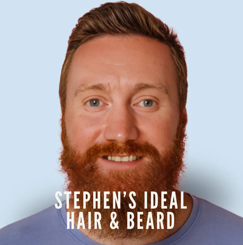 best beard transplant Stephens beard and hair transplant