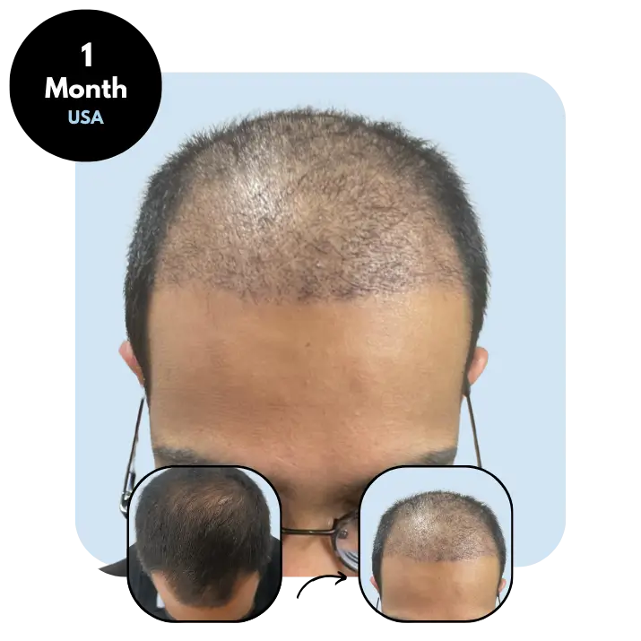 K.B. (27) from USA after hair transplant 1 month
