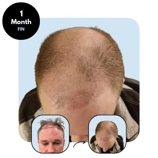 K.S. (38) from Finland after hair transplant 1 month