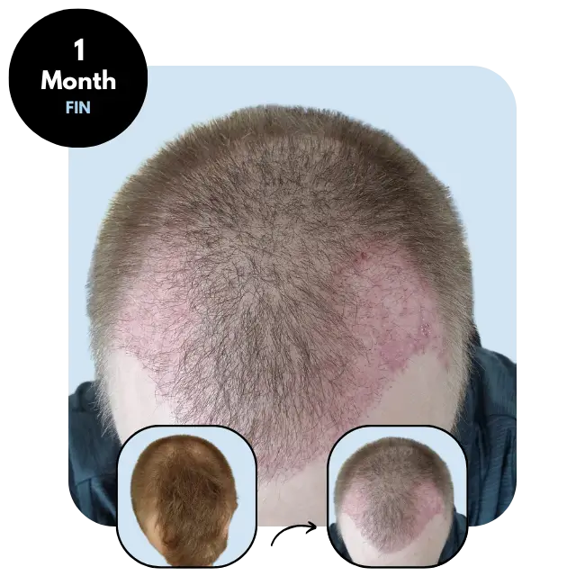 M.P. (27) from Finland after hair transplant 1 month