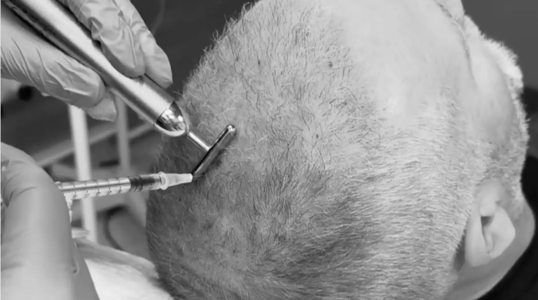 A Comprehensive Guide to Exosome Therapy for Hair Loss