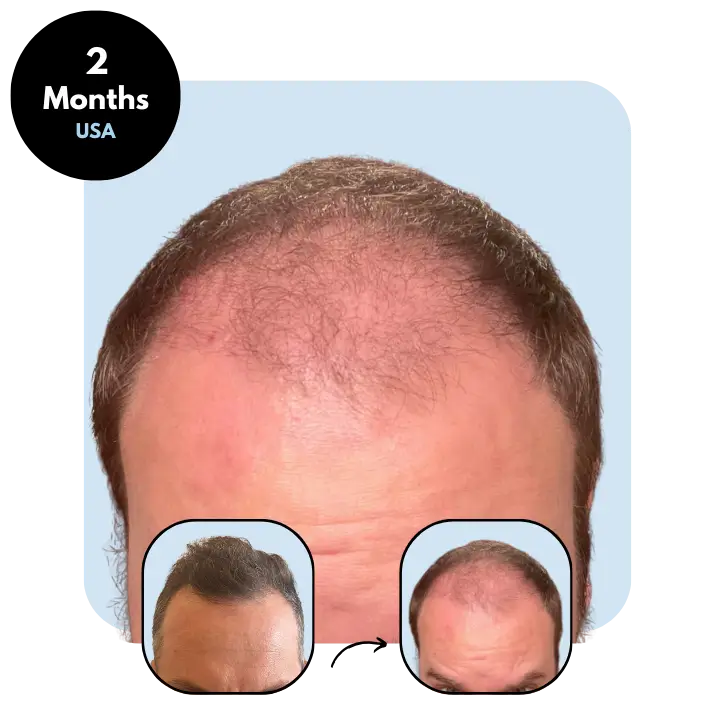 N.B. (36) from USA after hair transplant month 2