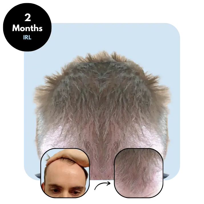 P.S. (25) from Ireland after hair transplant month 2 (Mix 4100 grafts)