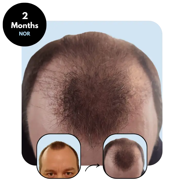 R.B. (42) from Norway after hair transplant month 2