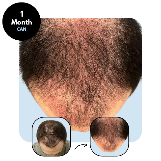 S.S. (36) from Canada after hair transplant 1 month