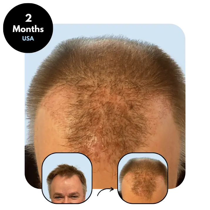 R.B. (57) from USA after hair transplant month 2