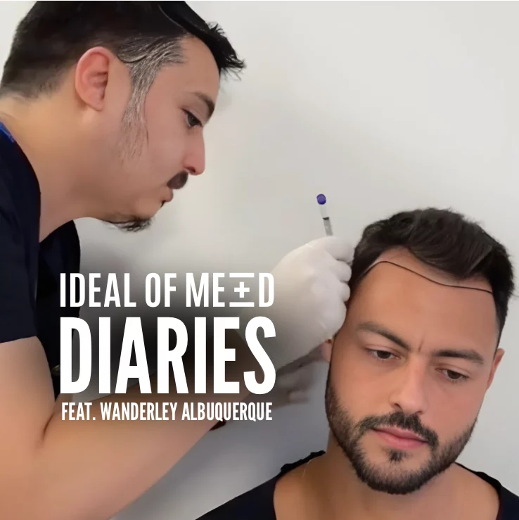 wanderley hair transplant