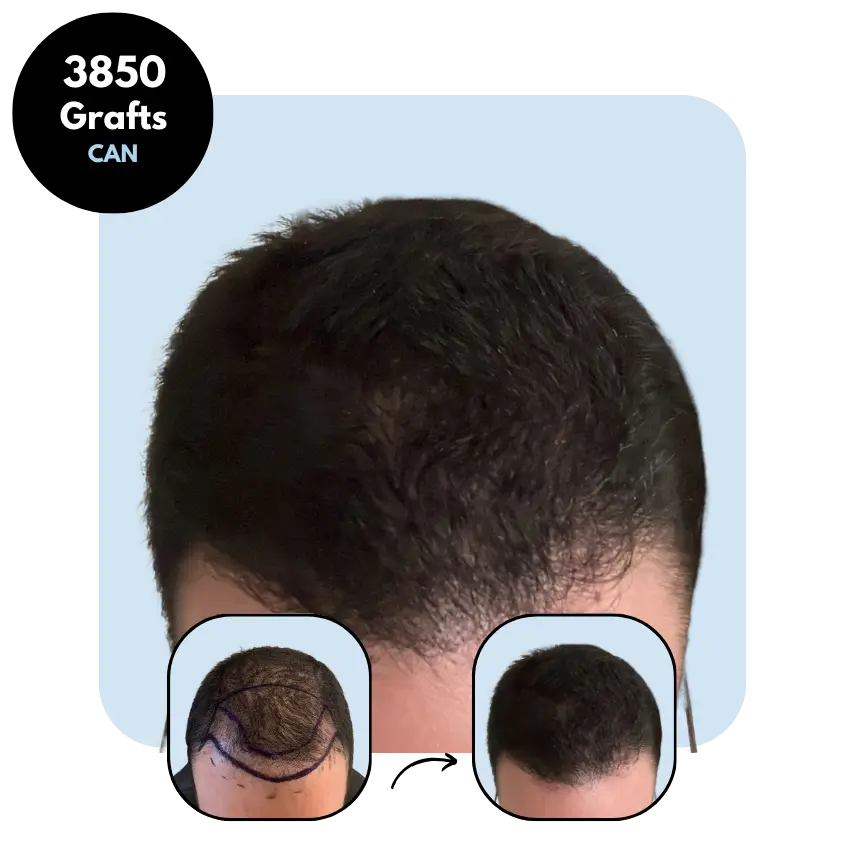H.A. (26) from UK hair transplant before and after (Mix 3850 grafts)