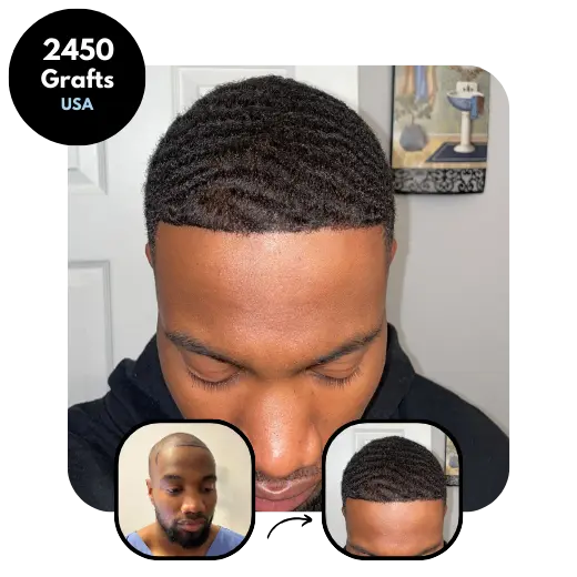 Afro FUE Hair transplant results 2450 grafts