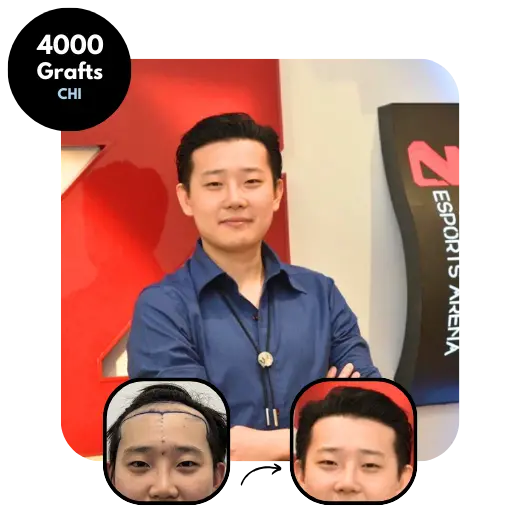 Asian FUE Hair transplant results 4000 grafts