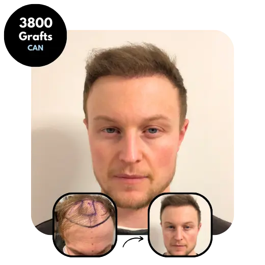 Combination Hair transplant results 3800 grafts