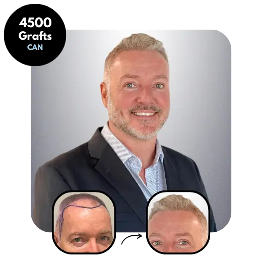 Combination Hair transplant results 4500 grafts