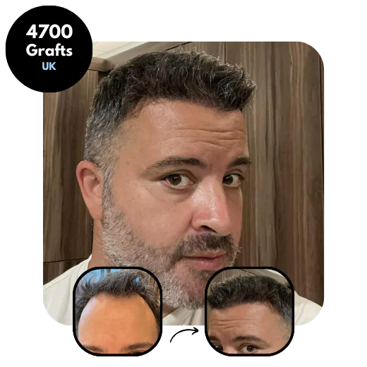 Combination Hair transplant results 4700 grafts