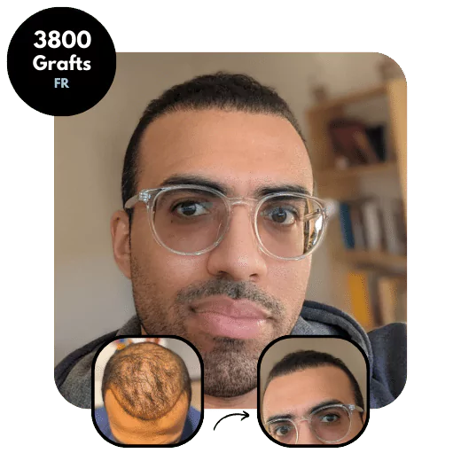 DHI Hair transplant results 3800x grafts