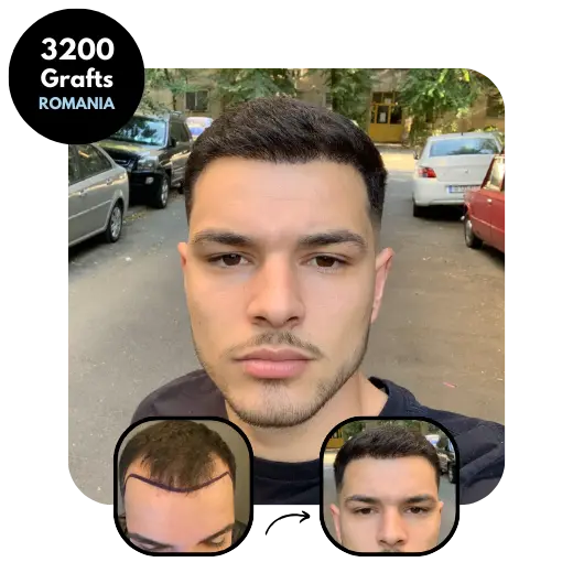 FUE Hair transplant results 3200 grafts