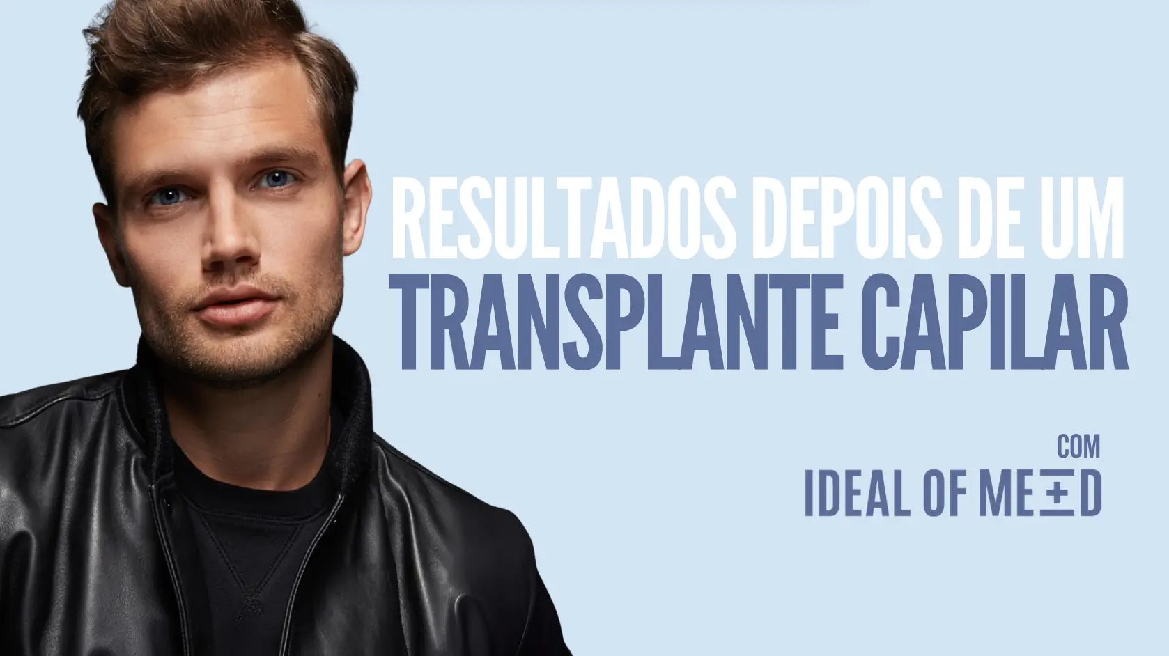 Resultados de Transplante Capilar Antes e Depois | Ideal of MeD