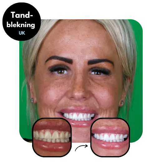 Tandblekning-Turkiet-fore-efter