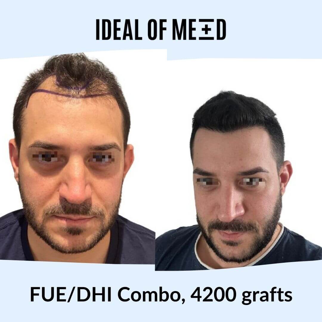 Before After Picture Hair Transplant IdealofMeD