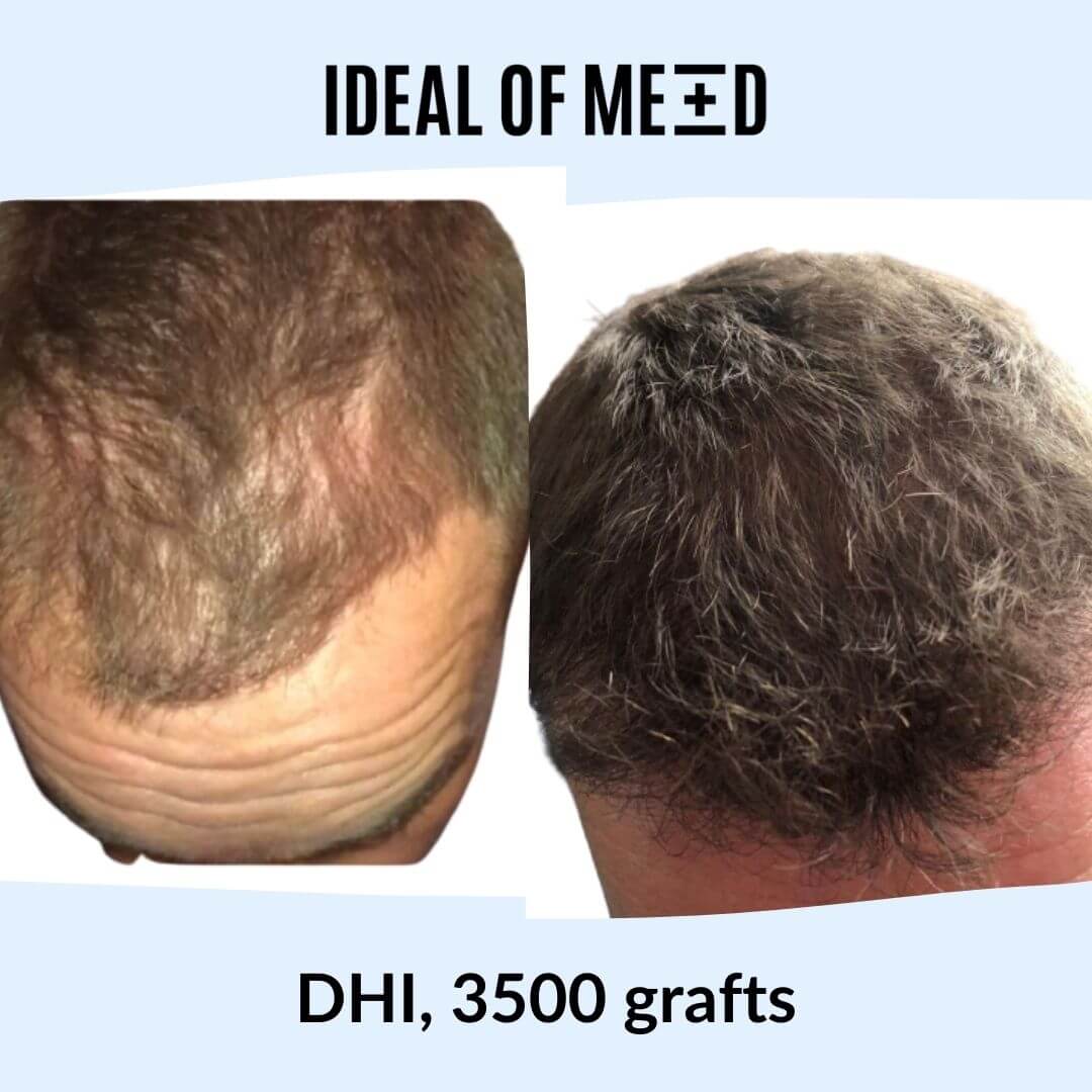 Before After Picture Hair Transplant IdealofMeD