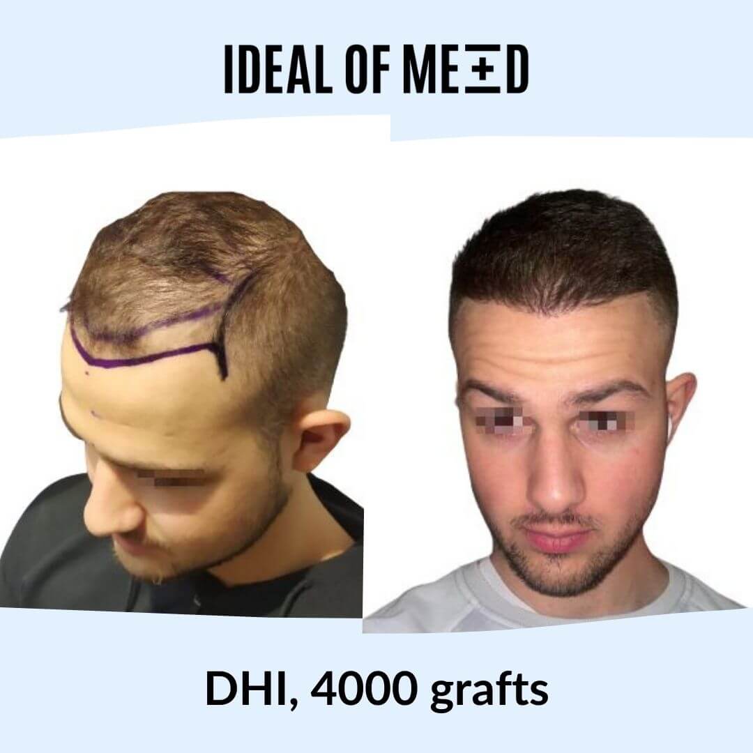 Before After Picture Hair Transplant IdealofMeD