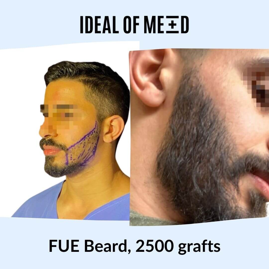 Before After Picture Beard Transplant IdealofMeD