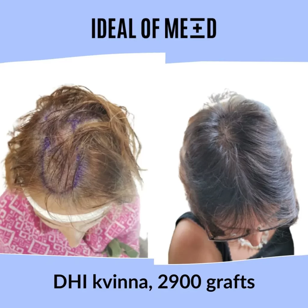Hårtransplantation kvinna 2900 grafts