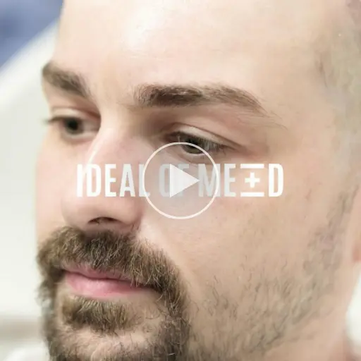 Matt from California - Hair transplant