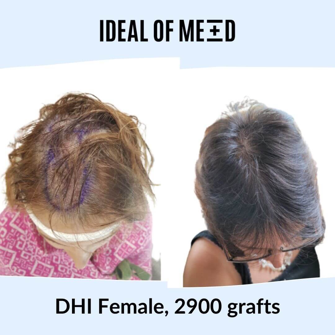 Before After Picture Female Hair Transplant IdealofMeD