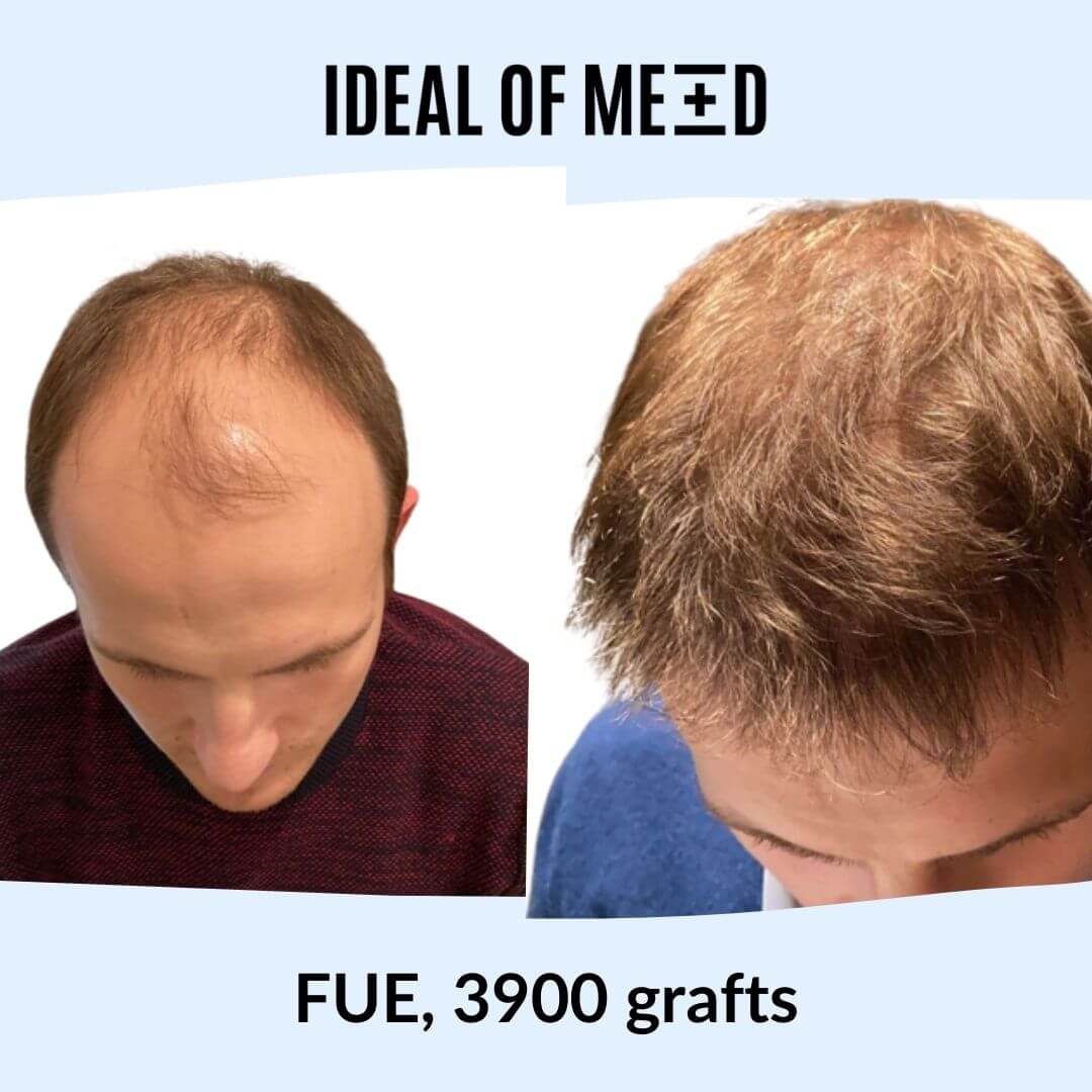 Before After Picture Hair Transplant IdealofMeD