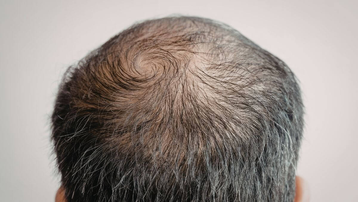 The Hair Transplant Crown Timeline, Month by Month